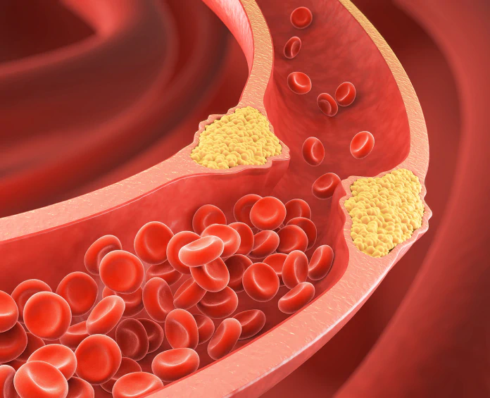 A medical rendering of a partially blocked artery with plaque buildup, highlighting the need for circulation supplements to support blood flow.