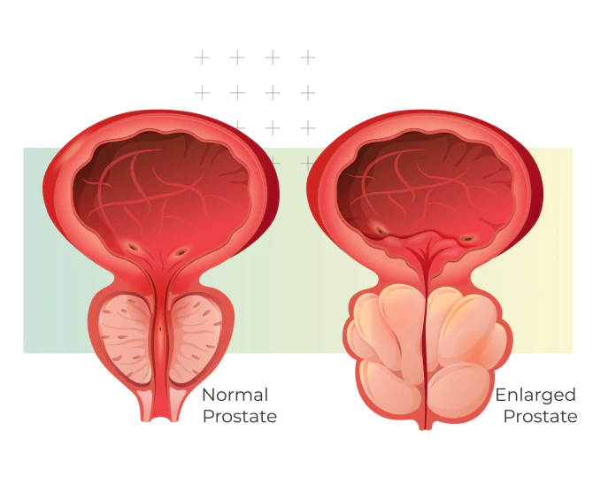 A man clutching his lower abdomen, representing discomfort and the need for the best supplements for prostate health.
