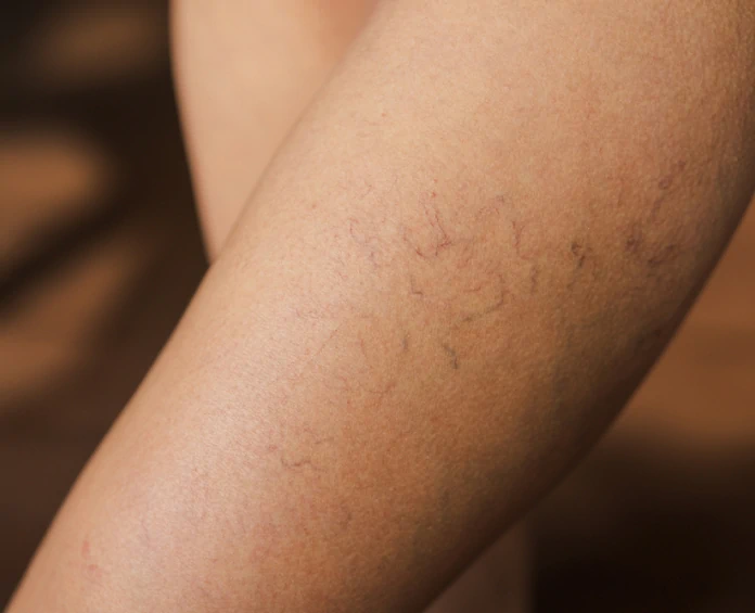 A person’s leg with visible spider veins, highlighting the importance of vein health supplements for circulation support.