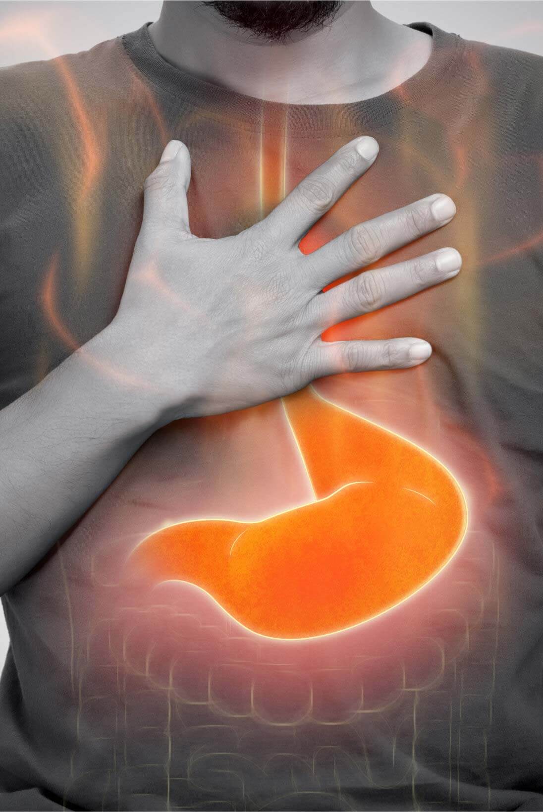 Acid Reflux