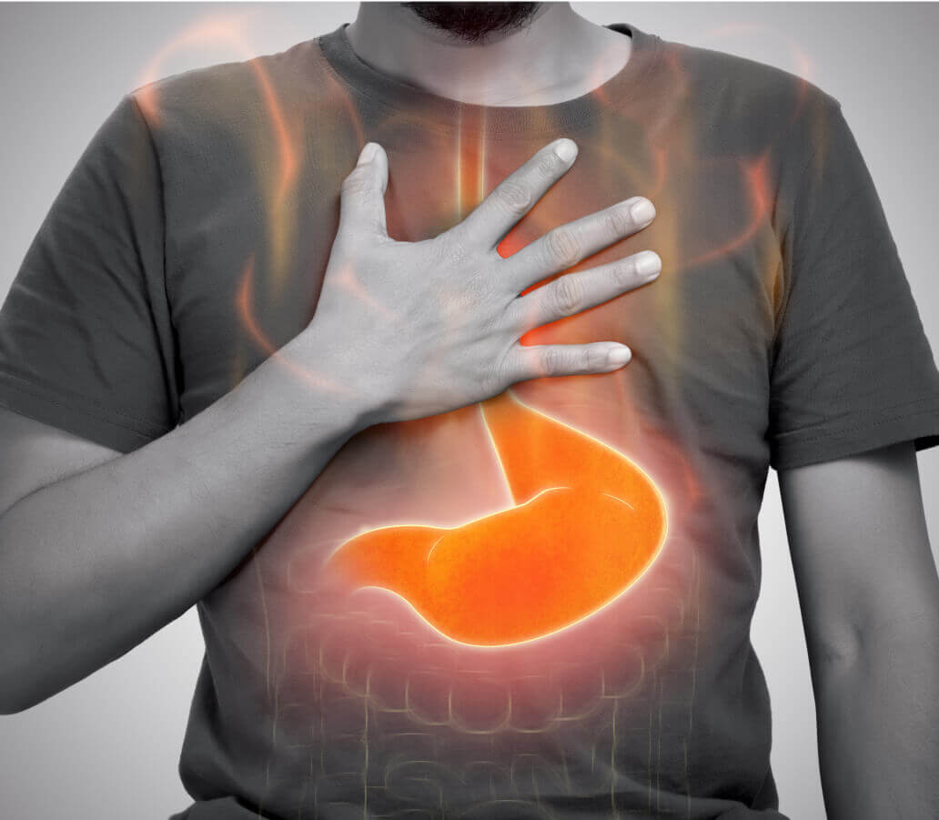 Acid Reflux